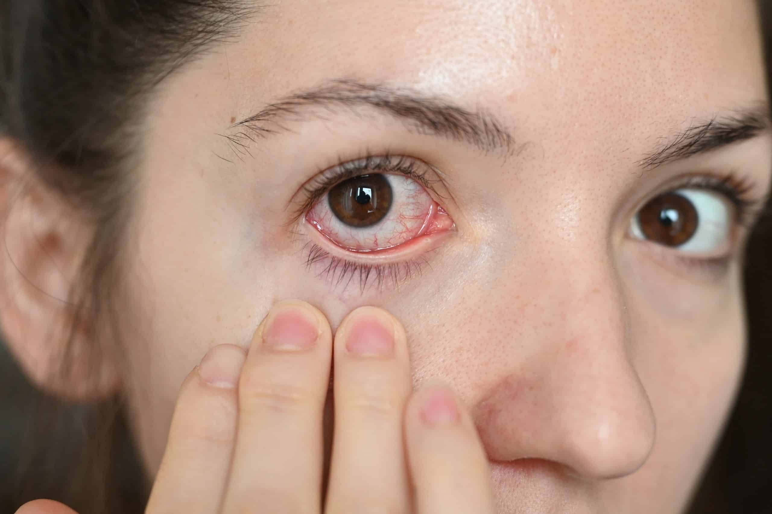 Dry Eye Disease Might Impact Corneal Regeneration medtigo