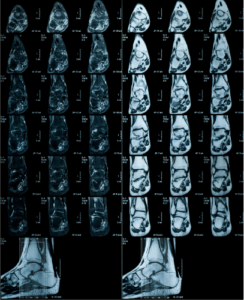 A Middle-Aged Man with Progressive Pain in the Sole of the Foot