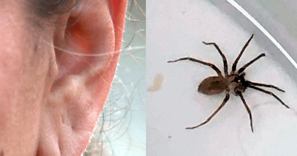 Unusual Medical Case Woman with a Spider in Her Ear Canal