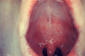 A child with white spots in the buccal cavity and high fever