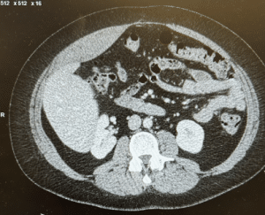 A middle-aged woman with hypertension and right lower quadrant pain