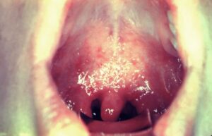 A child with white spots in the buccal cavity and high fever