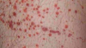 A middle-aged man with severe headache, neck stiffness and confusion