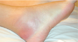 A middle-aged woman with fever, severe pain, and swelling in the ankle