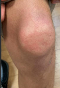 A male patient with rash on knees and sore throat