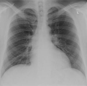 An older adult with shortness of breath and chest pain