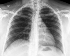 A middle-aged poultry worker with fever, cough and fatigue