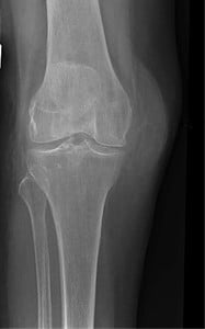 A young adult with a severed artery following an automobile accident