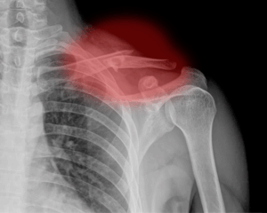 A middle-aged man with progressive left shoulder pain