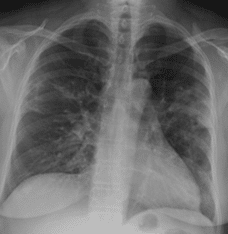 A middle-aged poultry worker with fever, cough and fatigue