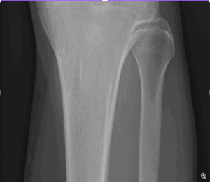 A young adult with a severed artery following an automobile accident