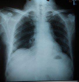An older adult with shortness of breath and chest pain