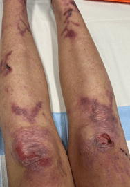 A middle-aged woman with unknown rash on lower extremities