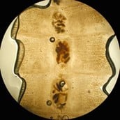 A middle-aged man with abdominal pain and fatigue