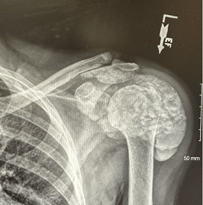 A middle-aged man with progressive left shoulder pain