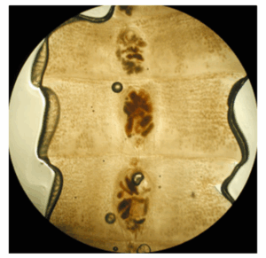 A middle-aged man with abdominal pain and fatigue