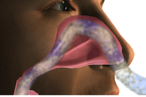 FDA Greenlights TEZSPIRE® for Nasal Polyps: First Biologic to Target TSLP
