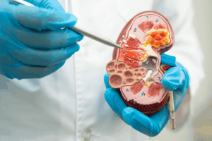 New Prediction Model Guides CKD Patients on Dialysis vs. Conservative Care