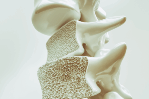 Spheroid Stem Cell Therapy: A Breakthrough for Osteoporotic Vertebral Fractures