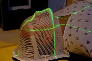 Dose-Dependent Effects of Radiotherapy on Olfactory Function in Head and Neck Cancer