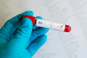 New Hope for Lupus Patients as nipocalimab Received FDA Fast Track Designation