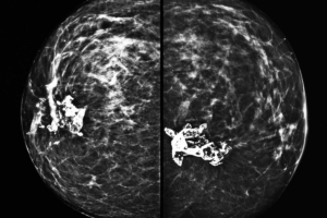 Breast Artery Calcification AI Model May Improve Heart Risk Prediction
